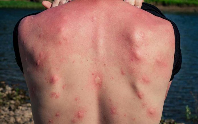 5 Ways to Avoid Insect Bites
