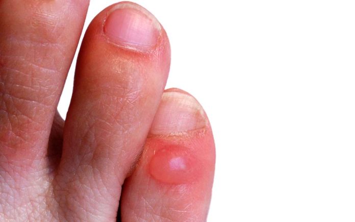 Blister Care and Prevention